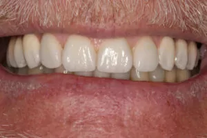 All on 4: Hybrid Restoration Dentist Davidson