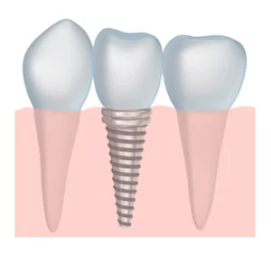 Benefits Dental Implant Image