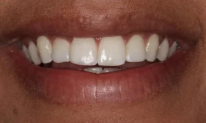 Composite Bonding Before and Afters