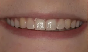 Composite Bonding Before and Afters