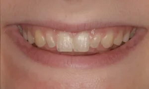 Composite Bonding Before and Afters