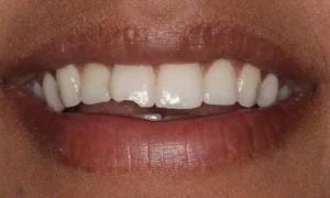 Composite Bonding Before and Afters