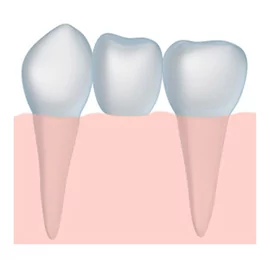 Dental Bridge