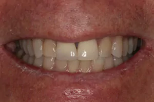 Porcelain Veneers Dentist Davidson