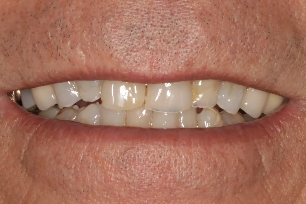 SmileMakeover Randy Before