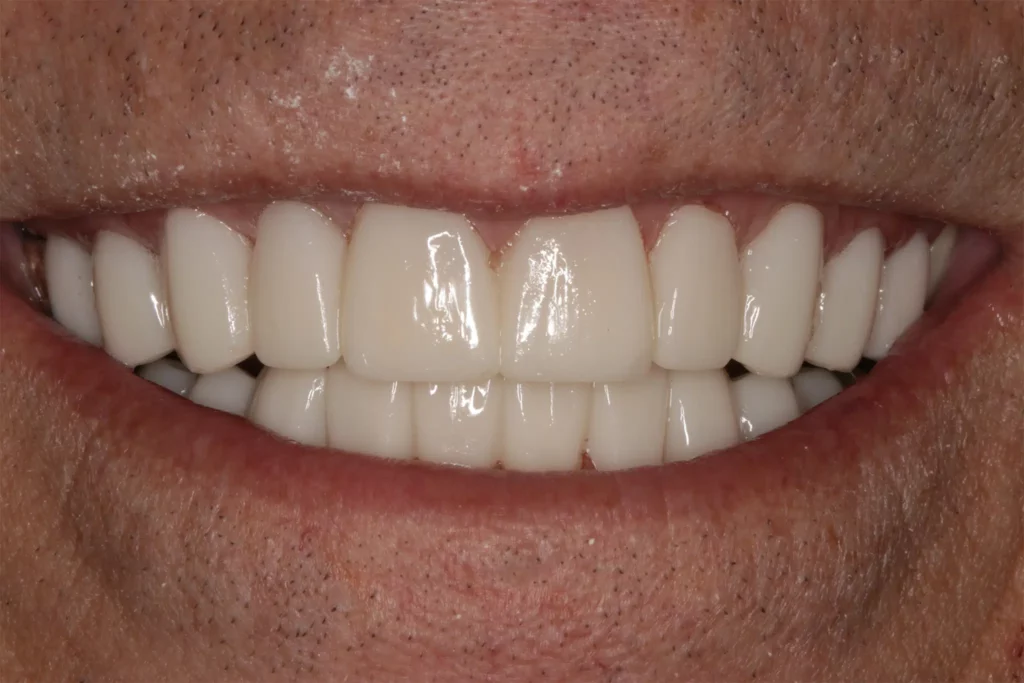 SmileMakeover Randy Temporary