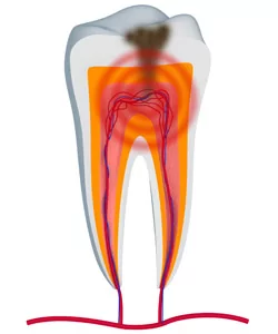 The Root Canal Procedure