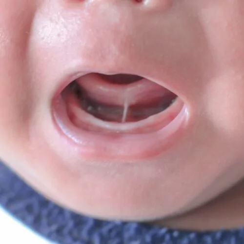 Tongue Tie Image