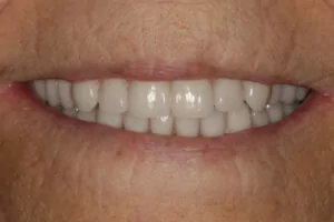 implant_denture_after-Image