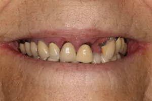 implant_denture_before Image