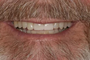 Porcelain Veneers Dentist Davidson