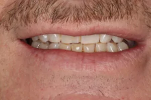 Veneers Dentist Davidson